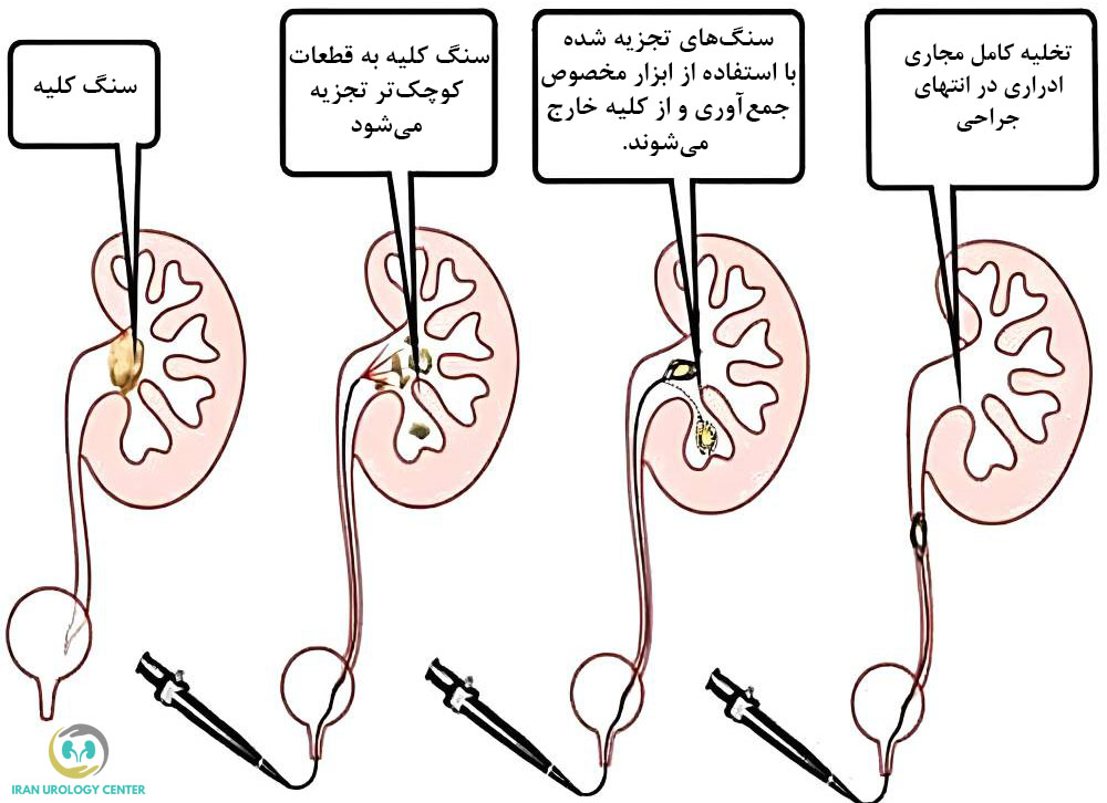 جراحی اورتروسکوپی سنگ کلیه از طریق مجاری ادراری
