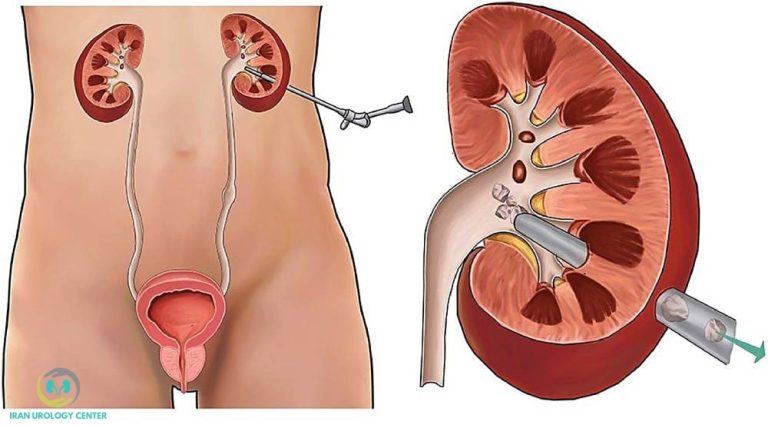 جراحی بسته سنگ کلیه به روش PCNL
