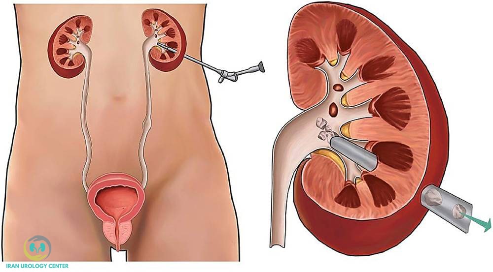 جراحی بسته سنگ کلیه به روش PCNL