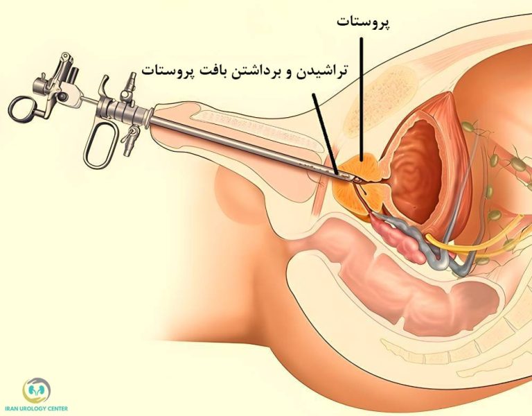 جراحی اندوسکوپی پروستات (TURP)