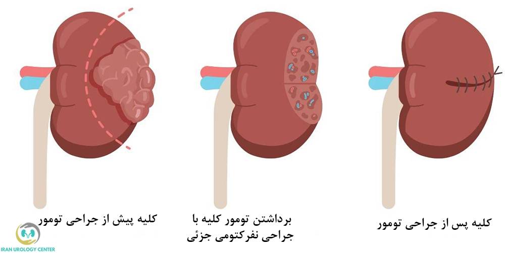 هدف از جراحی تومور کلیه چیست؟