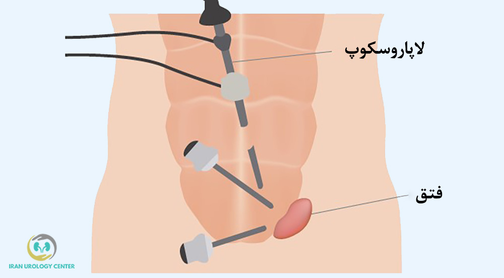 جراحی لاپاروسکوپی