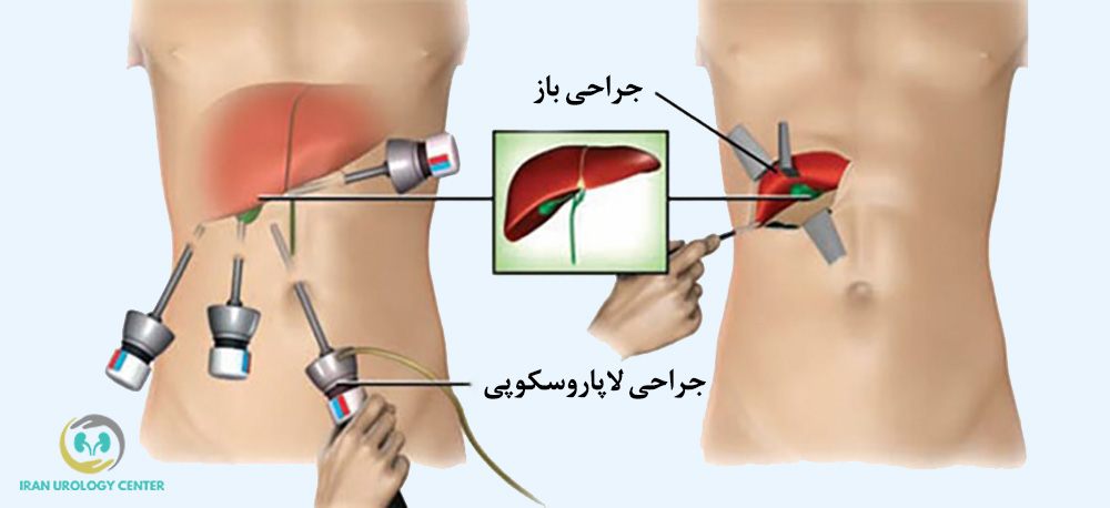 جراحی لاپاروسکوپی