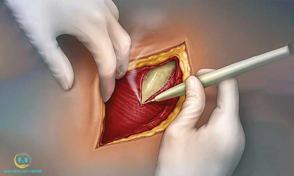 آدرنالکتومی به شیوه جراحی باز