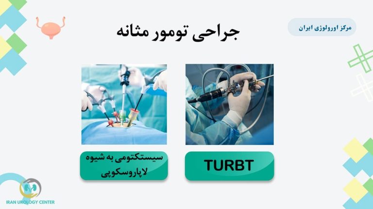 جراحی تومور مثانه