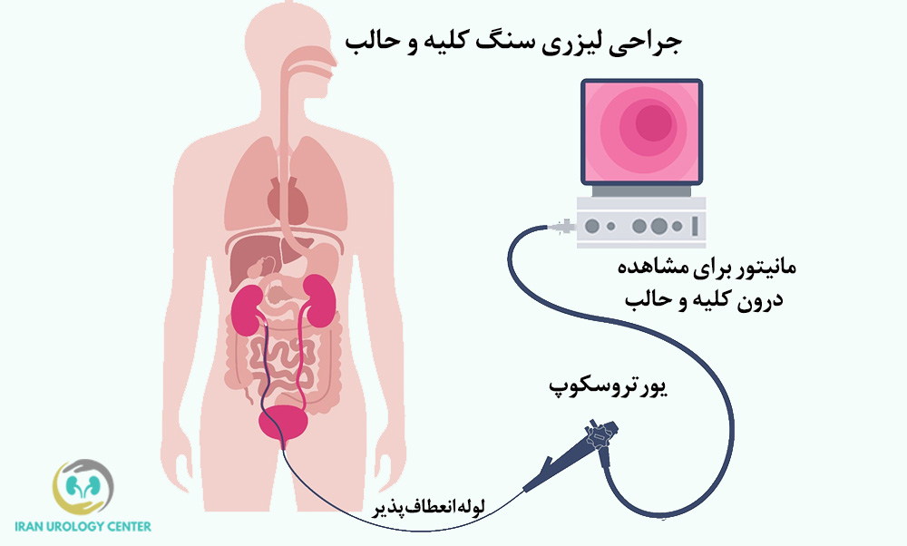 جراحی لیزری سنگ کلیه و حالب