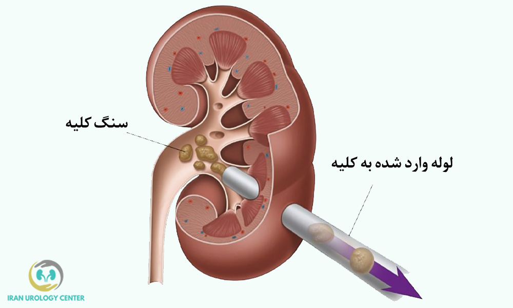 لوله وارد شده به درون کلیه
