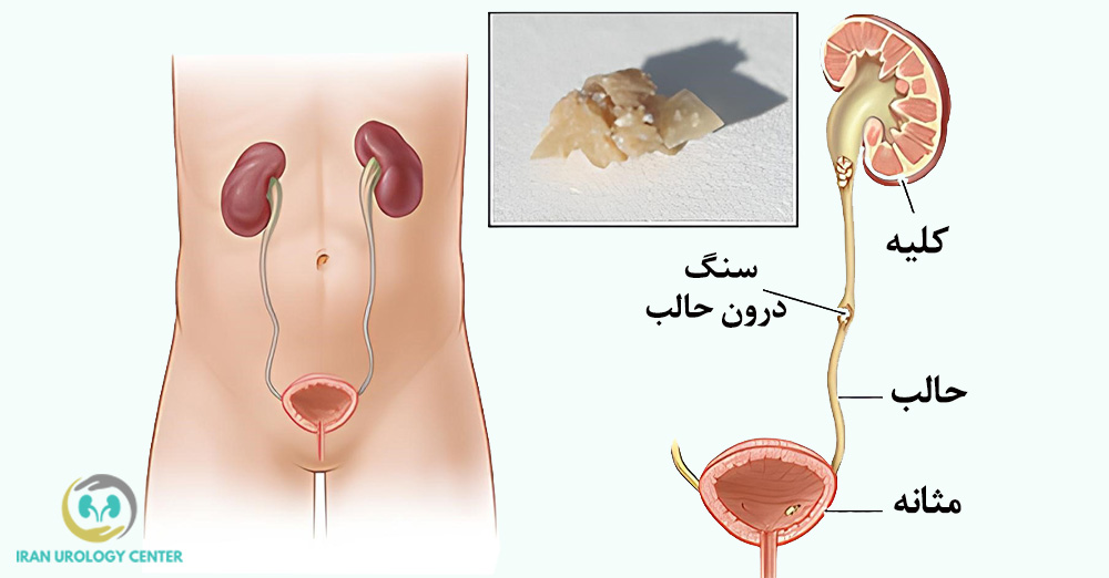 سنگ کلیه و حالب