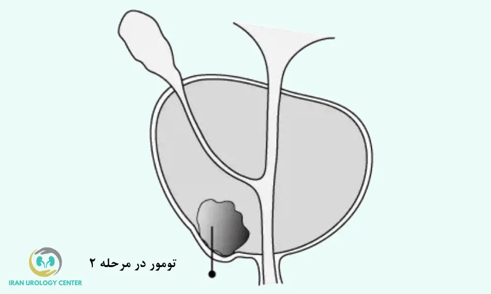 تومور در مرحله 2