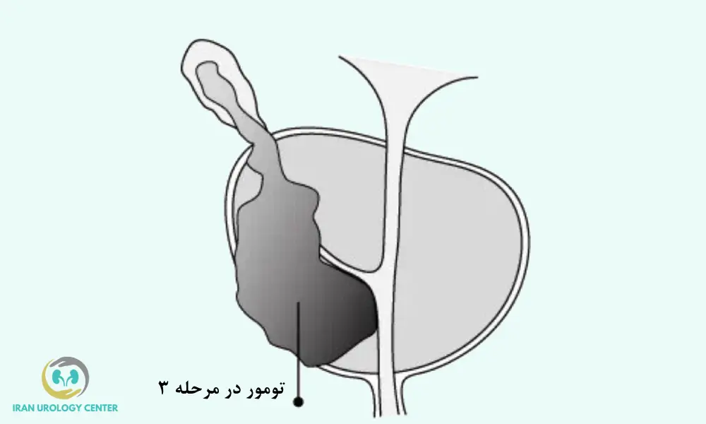 تومور در مرحله 3