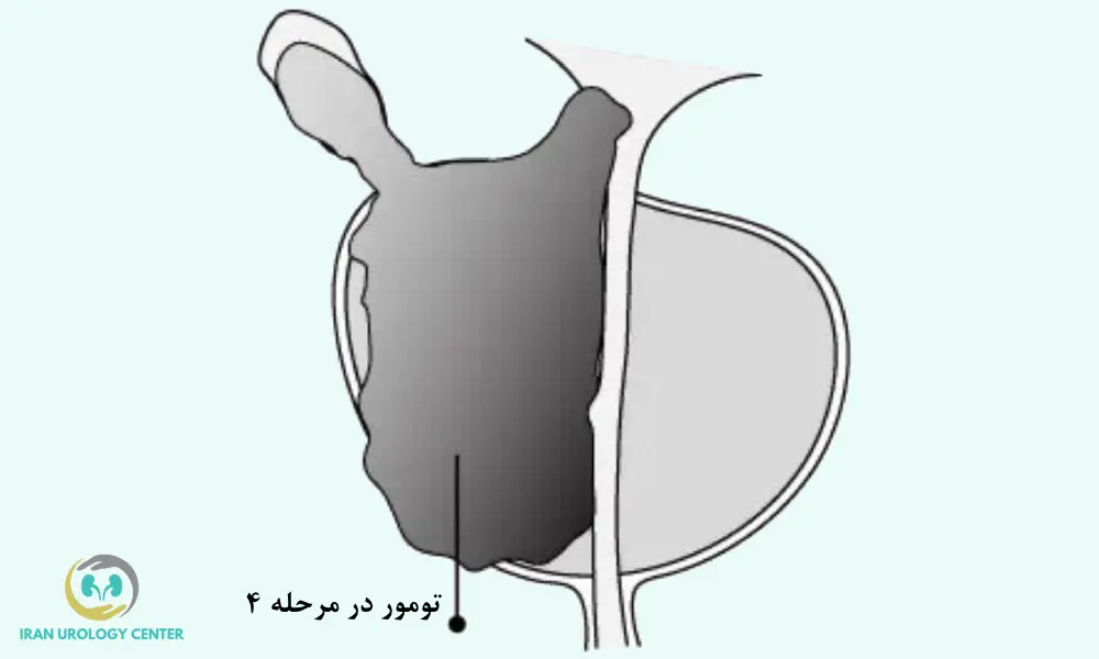 تومور در مرحله 4