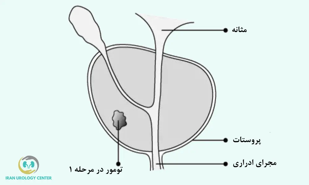 تومور در مرحله 1