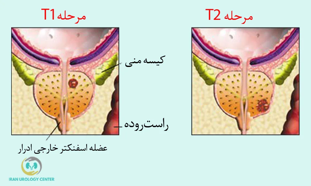 پروستاتکتومی رادیکال 