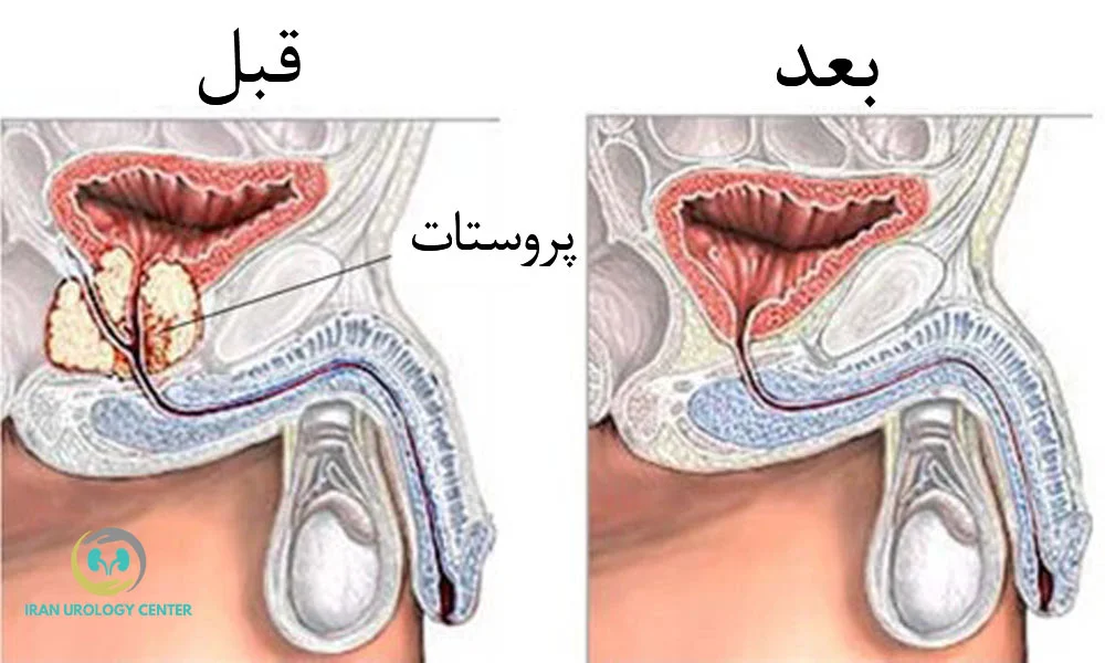 پروستات 
