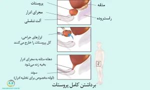 برداشتن پروستات