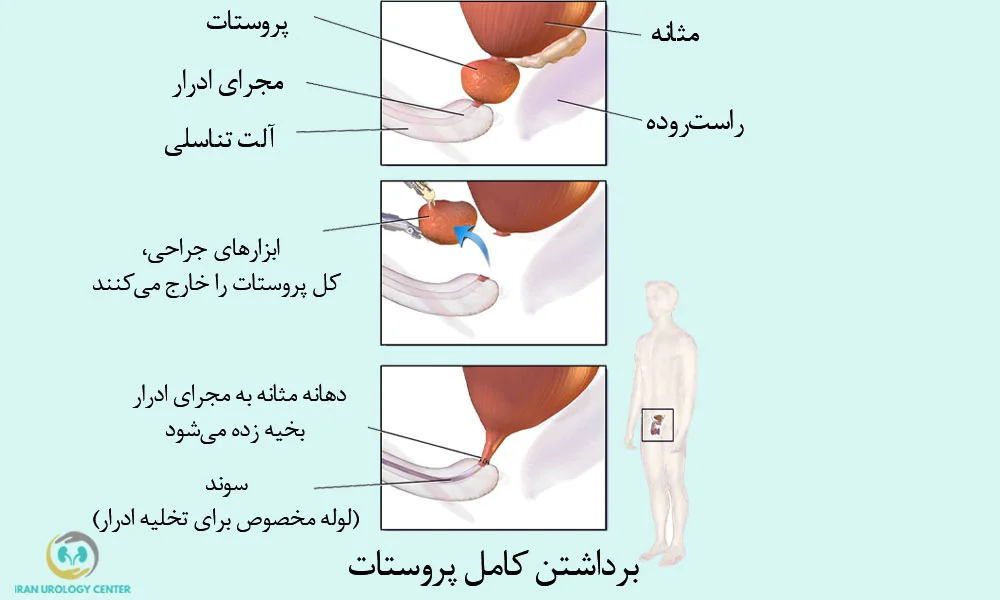 برداشتن پروستات