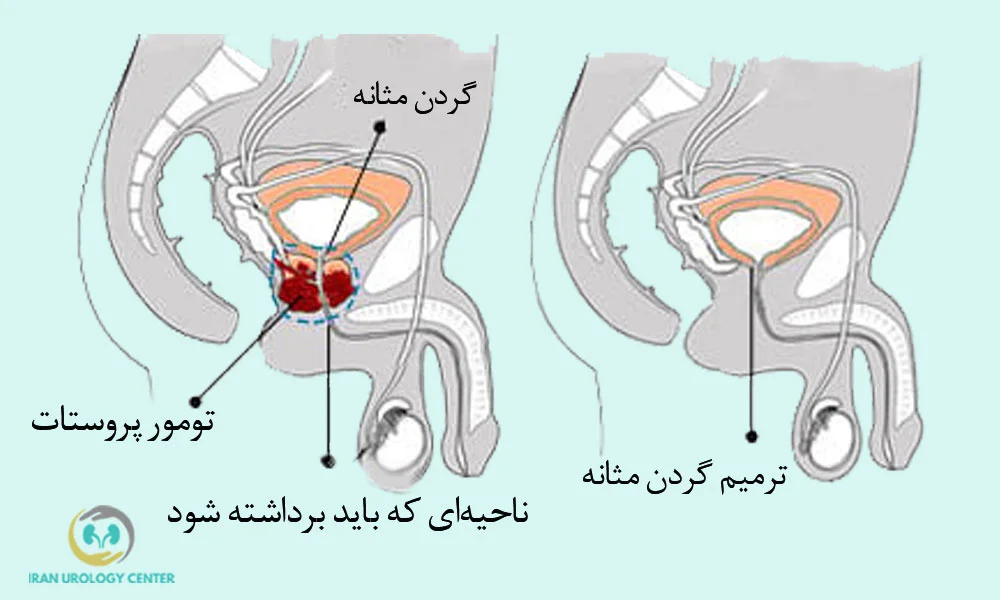 مراحل انجام عمل پروستاتکتومی رادیکال 