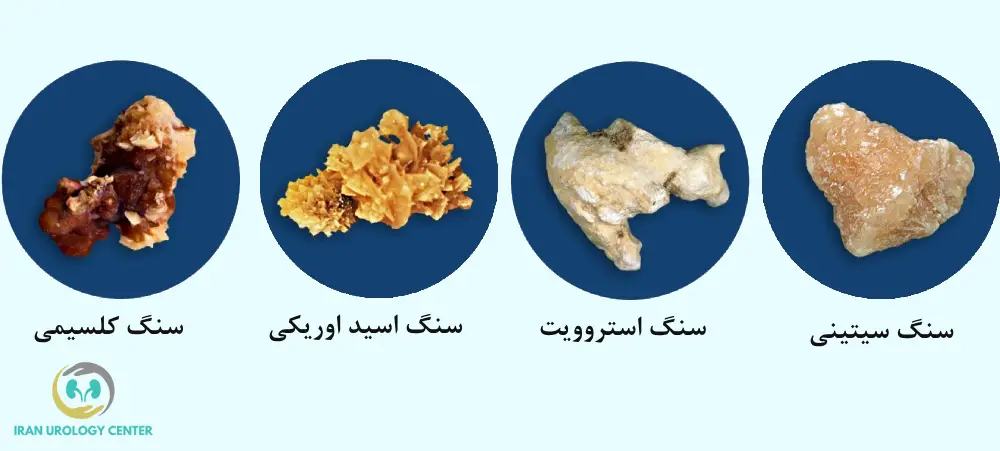 نوع سنگ کلیه