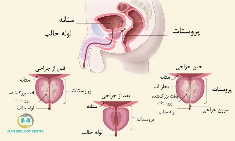 درمان پروستات با بخار آب