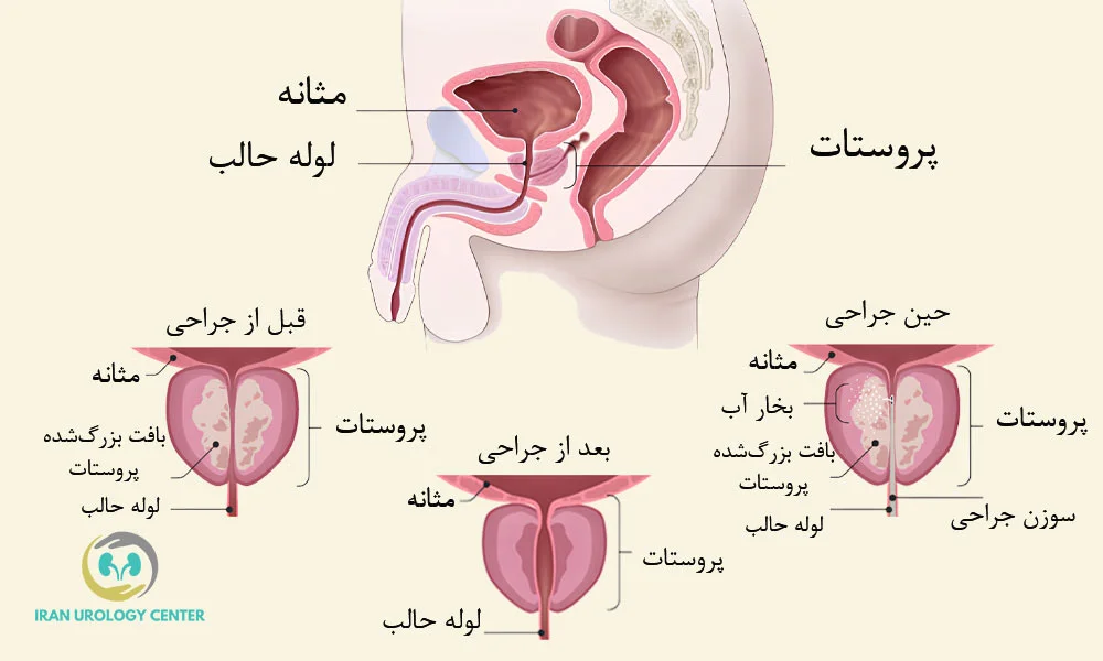 درمان پروستات با بخار آب